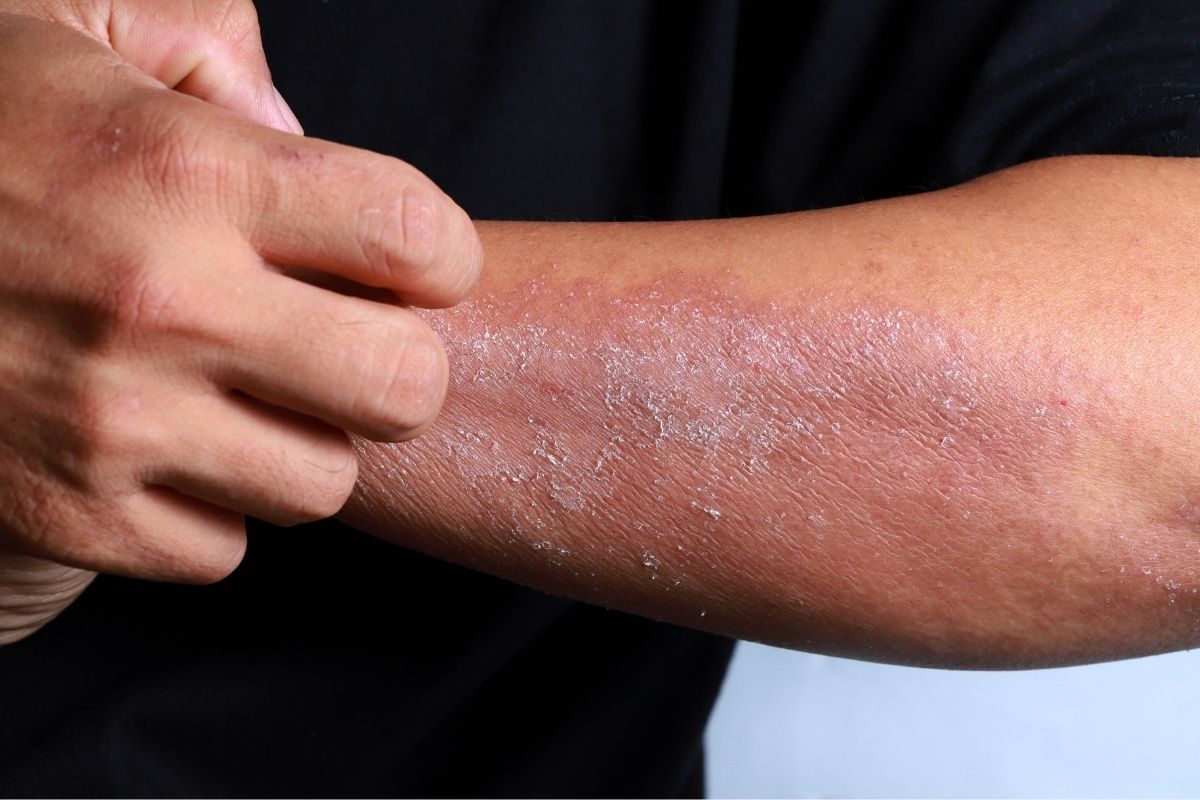 Nước đá sạch giúp giảm dị ứng da như thế nào