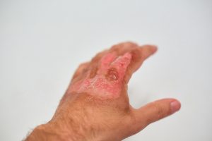 Read more about the article Tại sao không nên để nước đá trực tiếp lên vết bỏng? Cách xử lý đúng an toàn